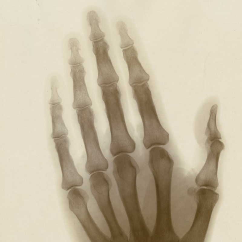 An early x-ray photograph of Sir William Crookes’s hand