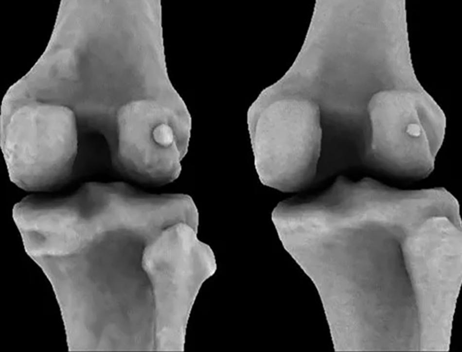 Do you have extra bones in your knee